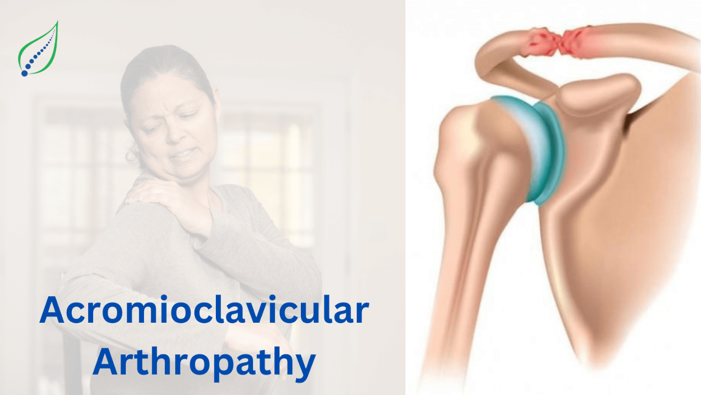 acromioclavicular-arthropathy