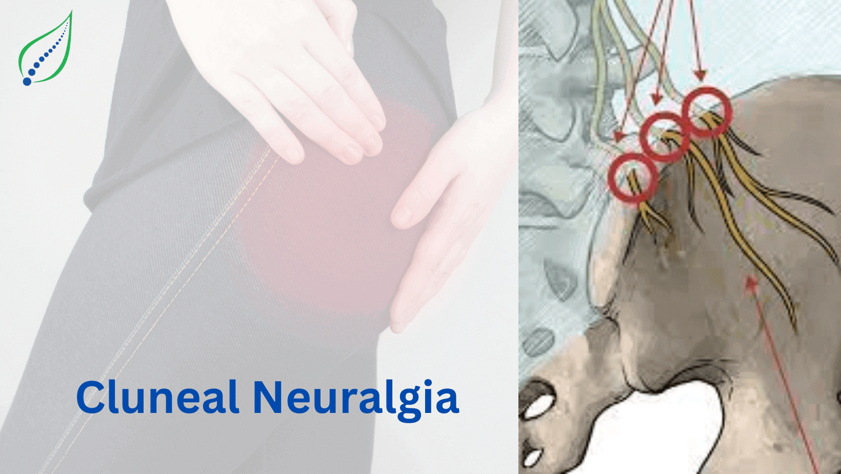 cluneal-neuralgia