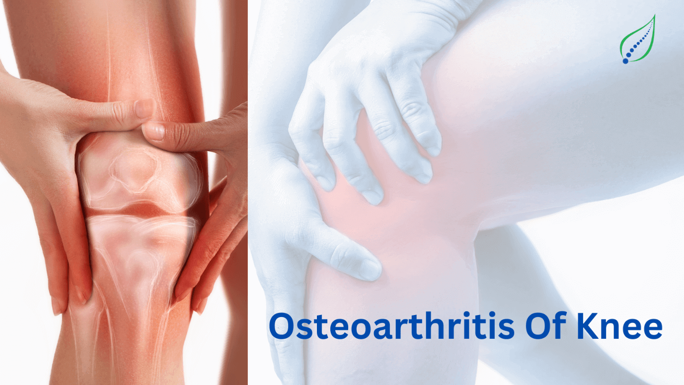osteoarthritis-of-knee