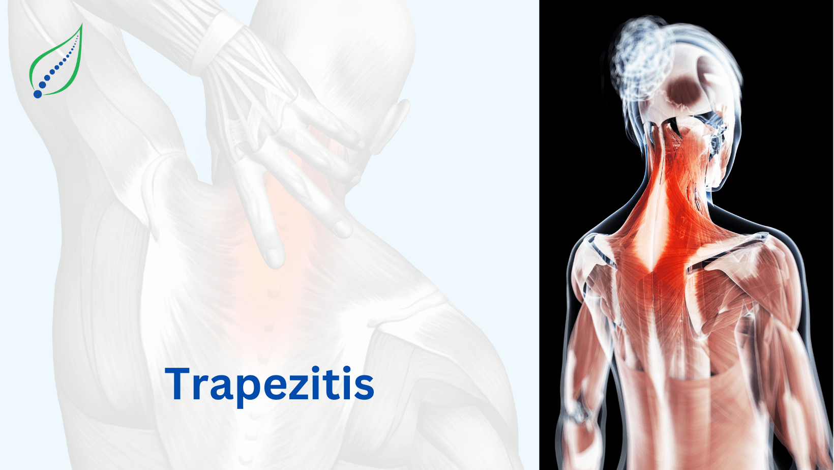 trapezitis
