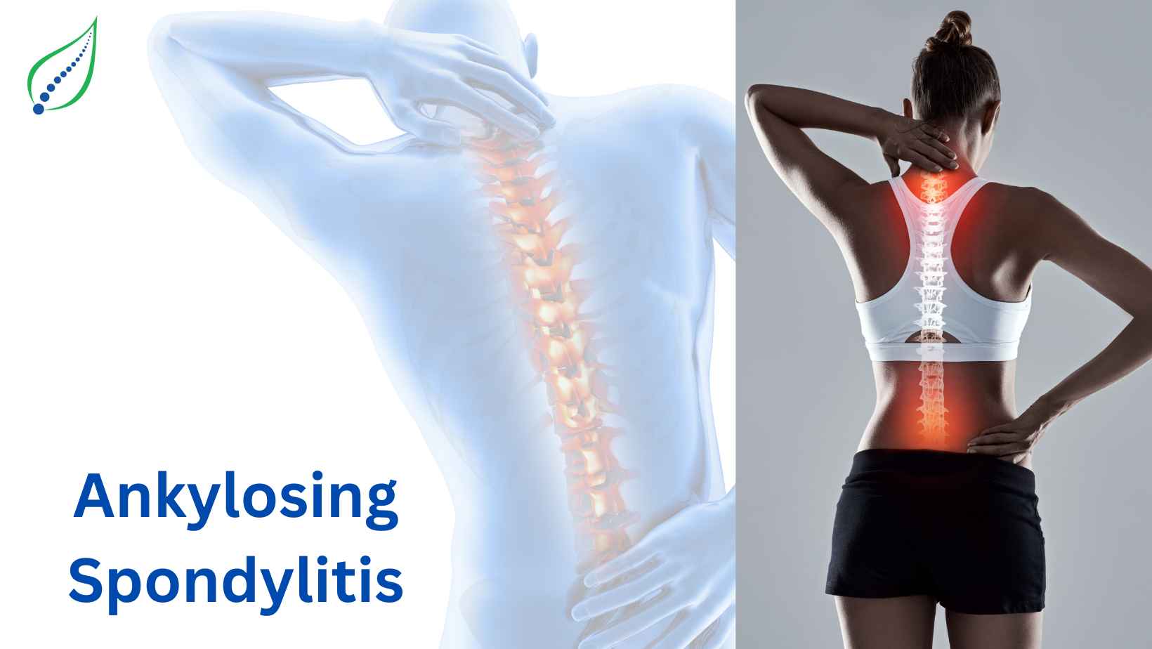 Understanding Ankylosing Spondylitis: Symptoms, Causes, and Treatment ...