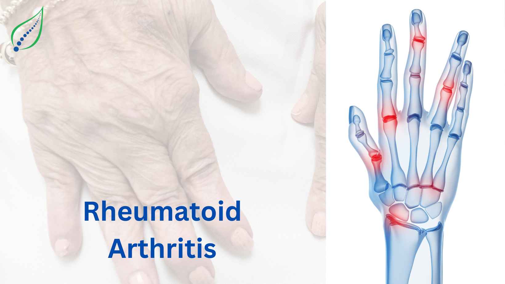 Effective Rheumatoid Arthritis Treatment | Spinalogy Clinic | Best Back ...