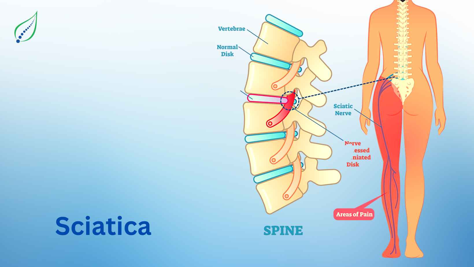 Effective Sciatica Treatment: Expert Care for Pain Relief, Spinalogy