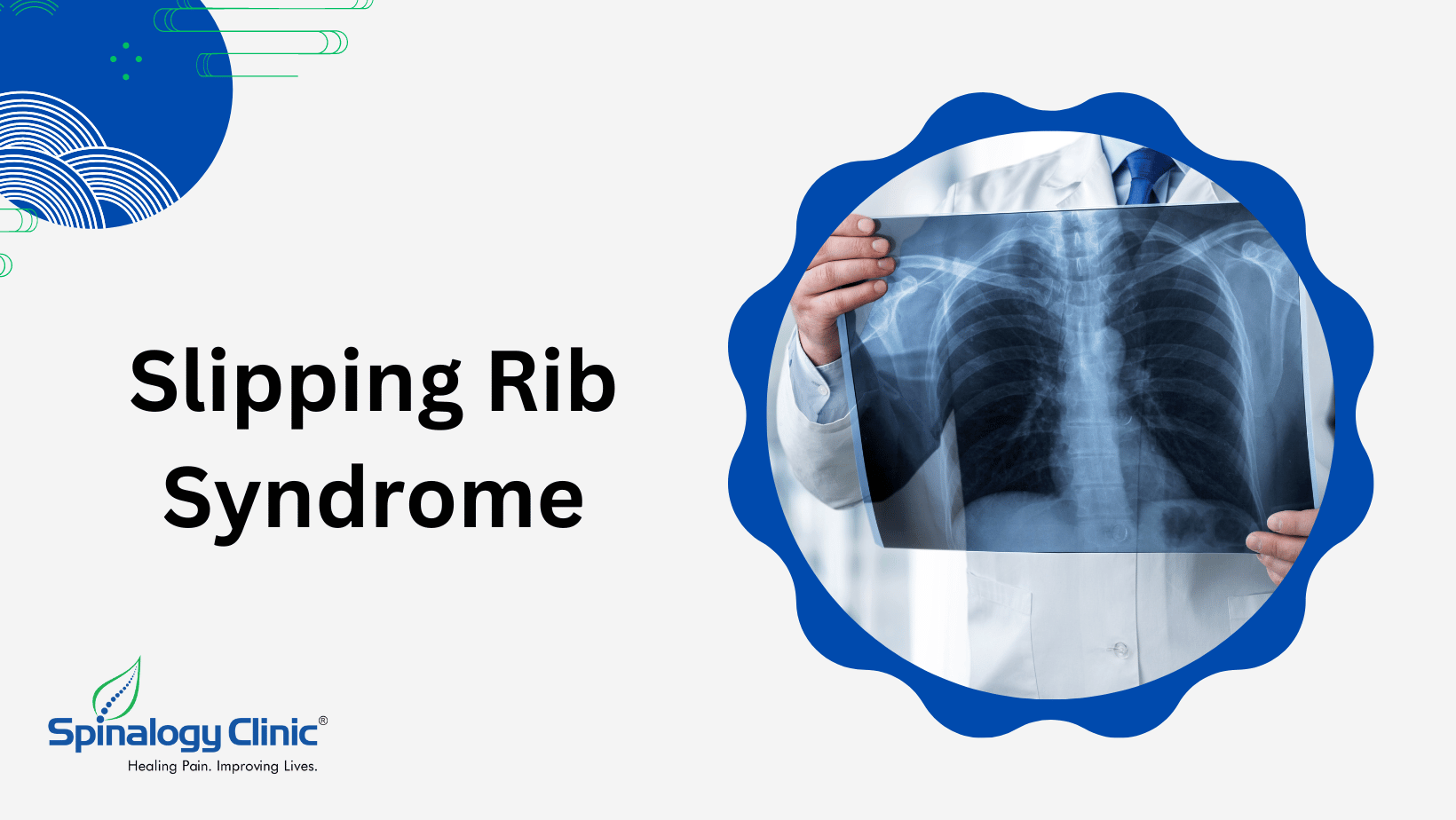 Understanding Slipping Rib Syndrome: Causes, Symptoms, and Treatment ...