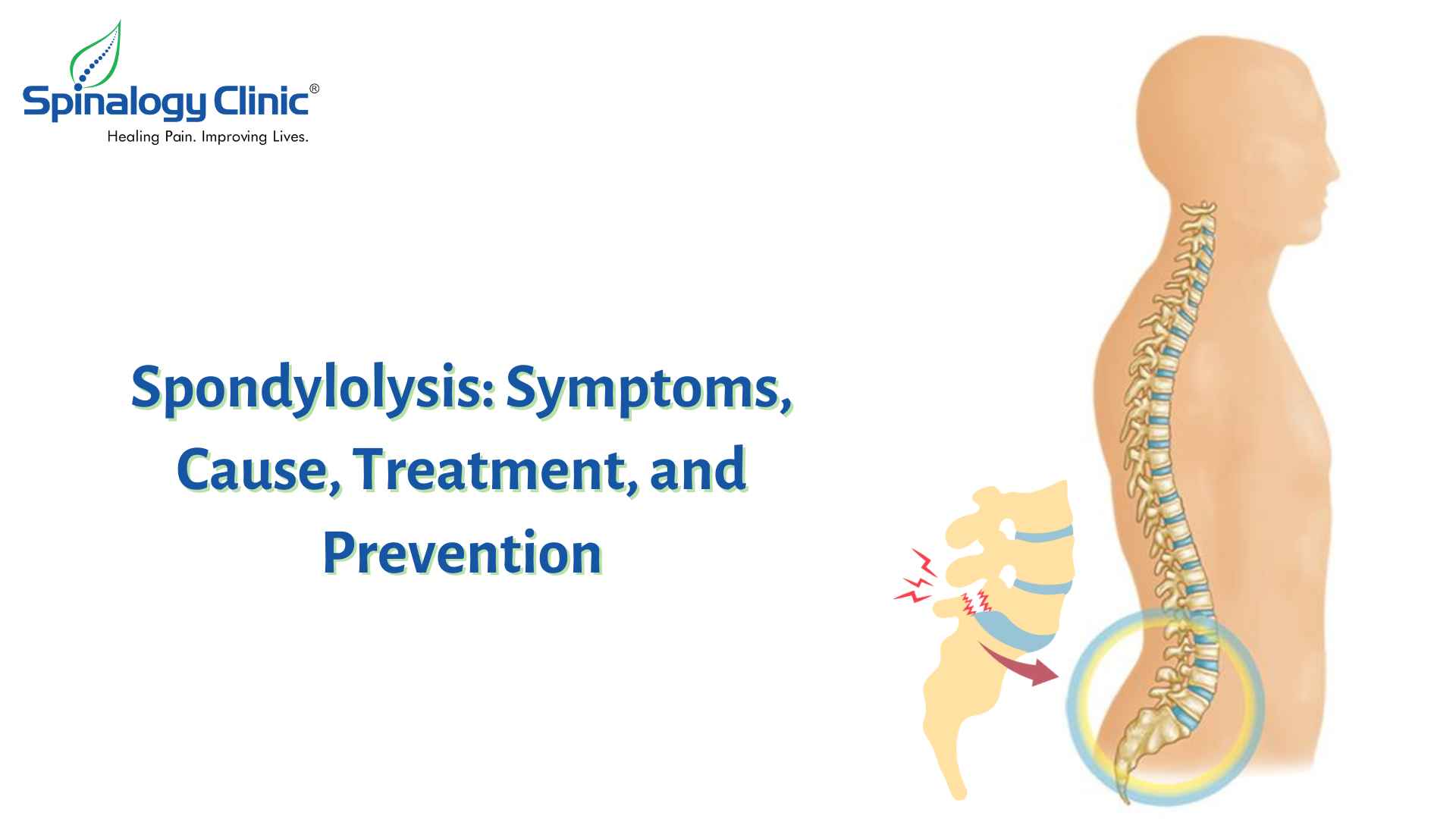 Spondylolysis: Symptoms, Cause, Treatment, and Prevention | Best Back ...
